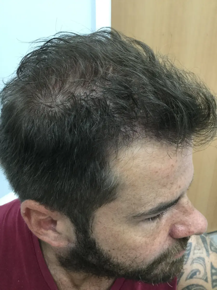 Owen, 7 months after his hair transplant